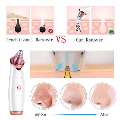 Facial Blackhead And Acne Electric Remover - Jscomfortzstore